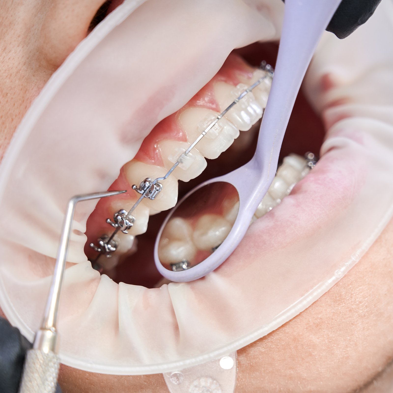 Soins dentaires professionnels chez Ayodent à Herve