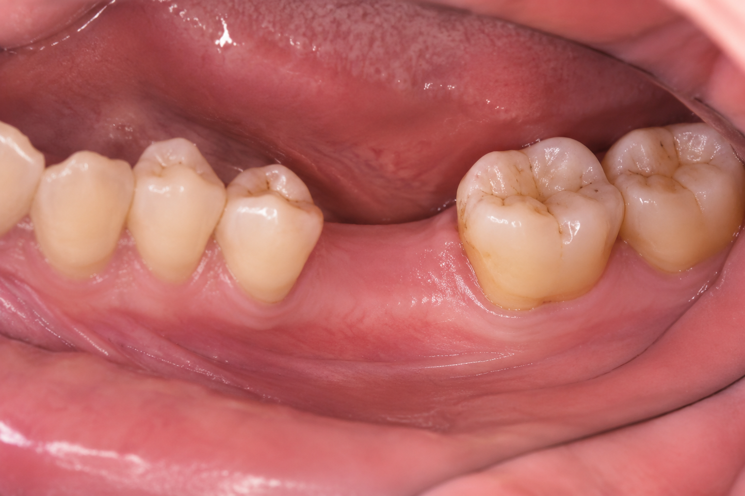 Situation initiale — Restaurer une mastication plus équilibrée chez AYODENT à Herve