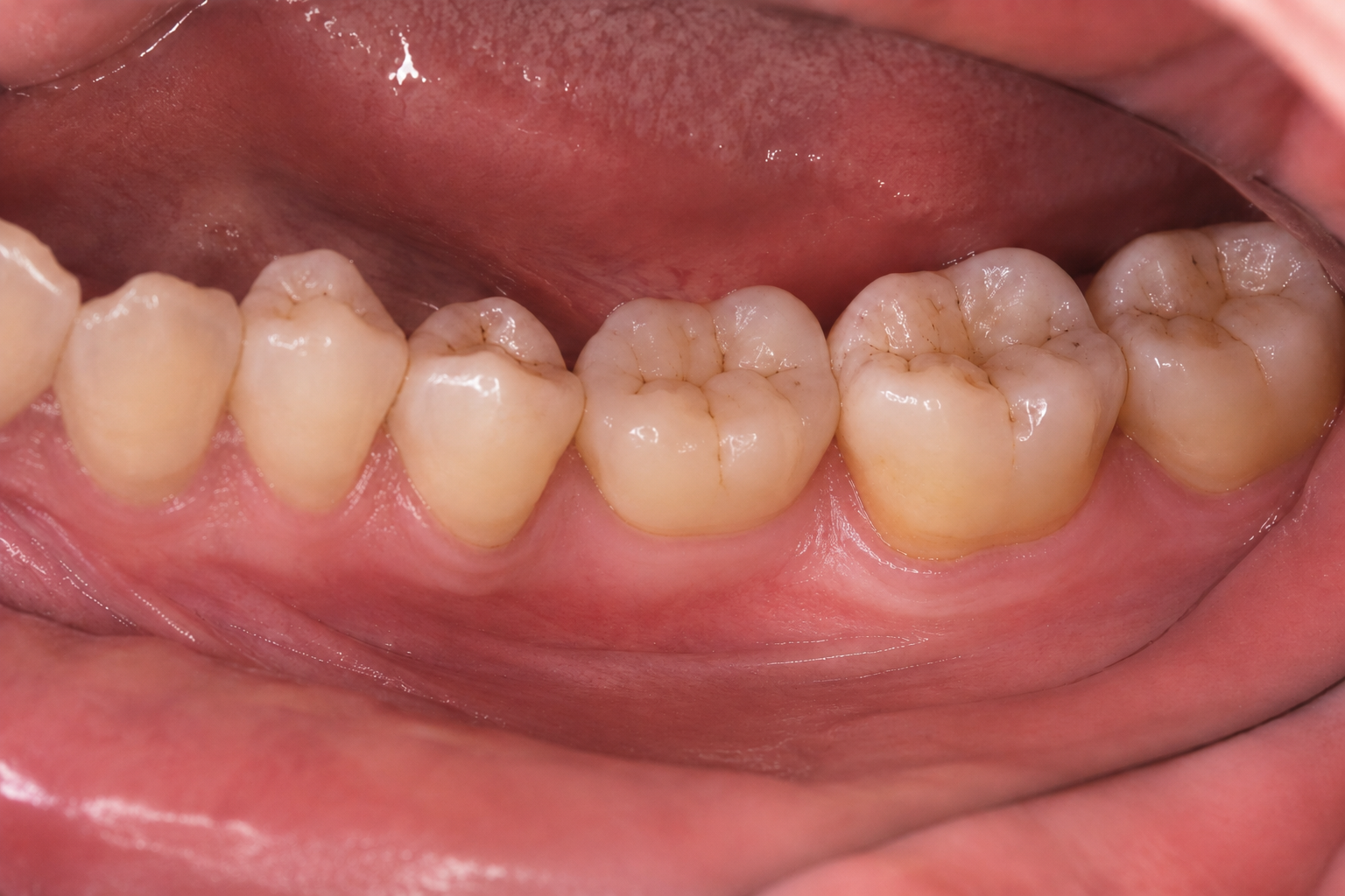 Résultat après traitement — Restaurer une mastication plus équilibrée chez AYODENT à Herve